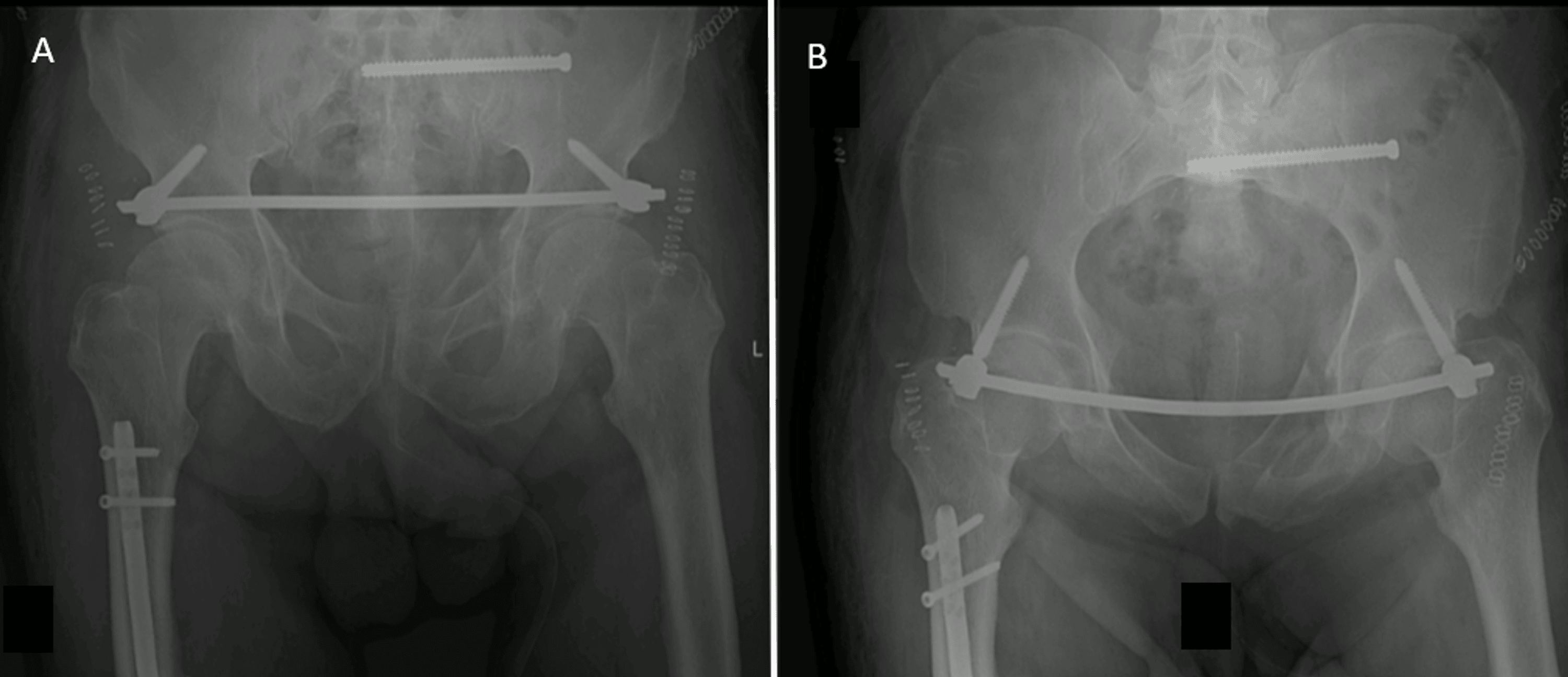 Cureus Risk of Anticoagulation in Gluteal Compartment Syndrome After