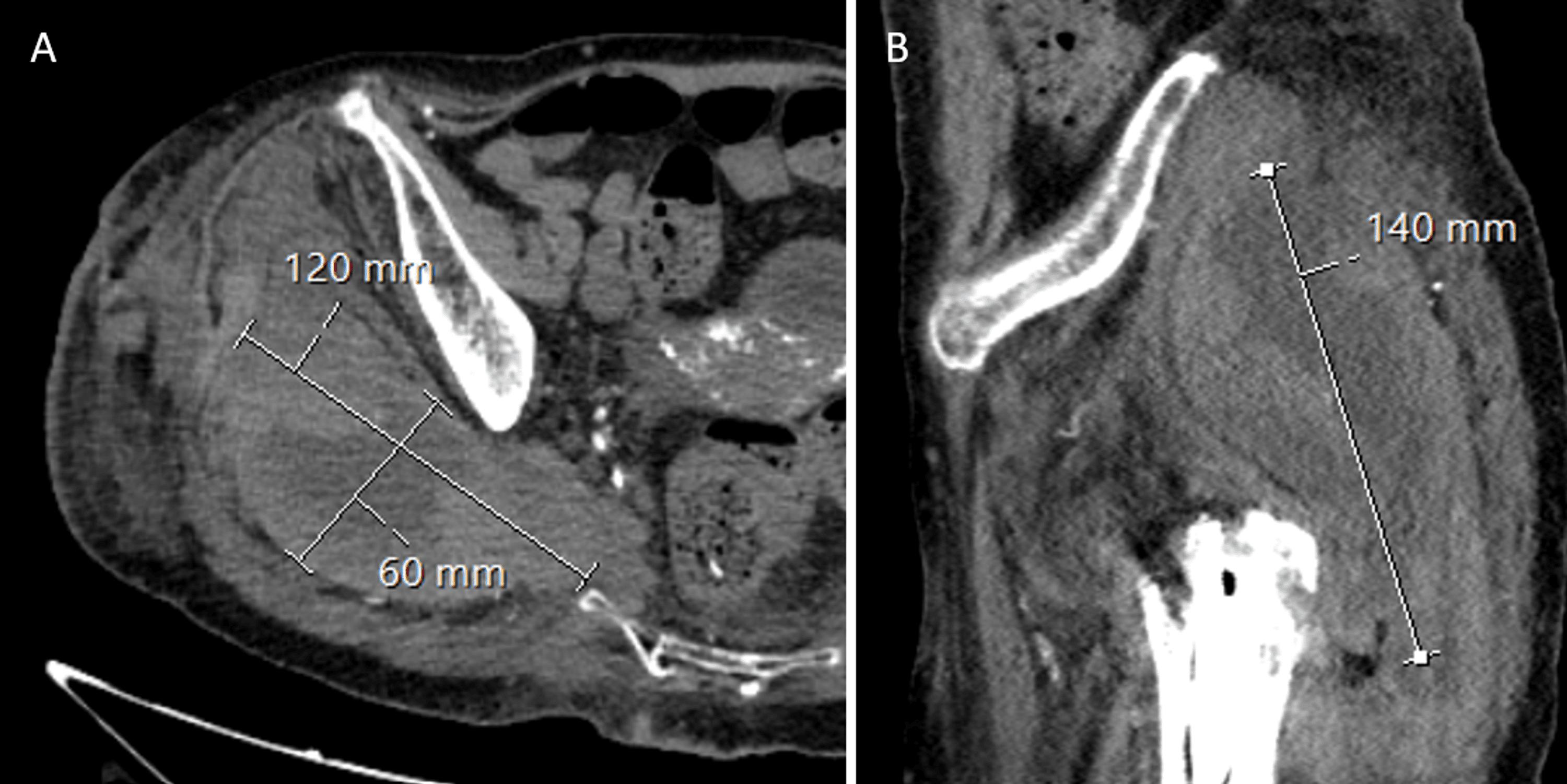 Cureus Risk of Anticoagulation in Gluteal Compartment Syndrome After