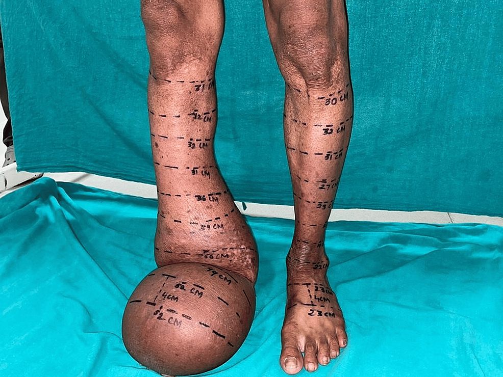 Lower Extremity Lymphedema and Edema