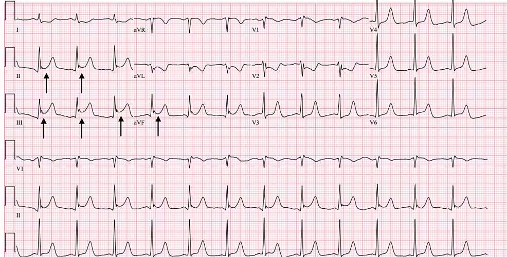 Cureus | Coronary Artery Vasospasm After Mechanical Aortic Valve ...