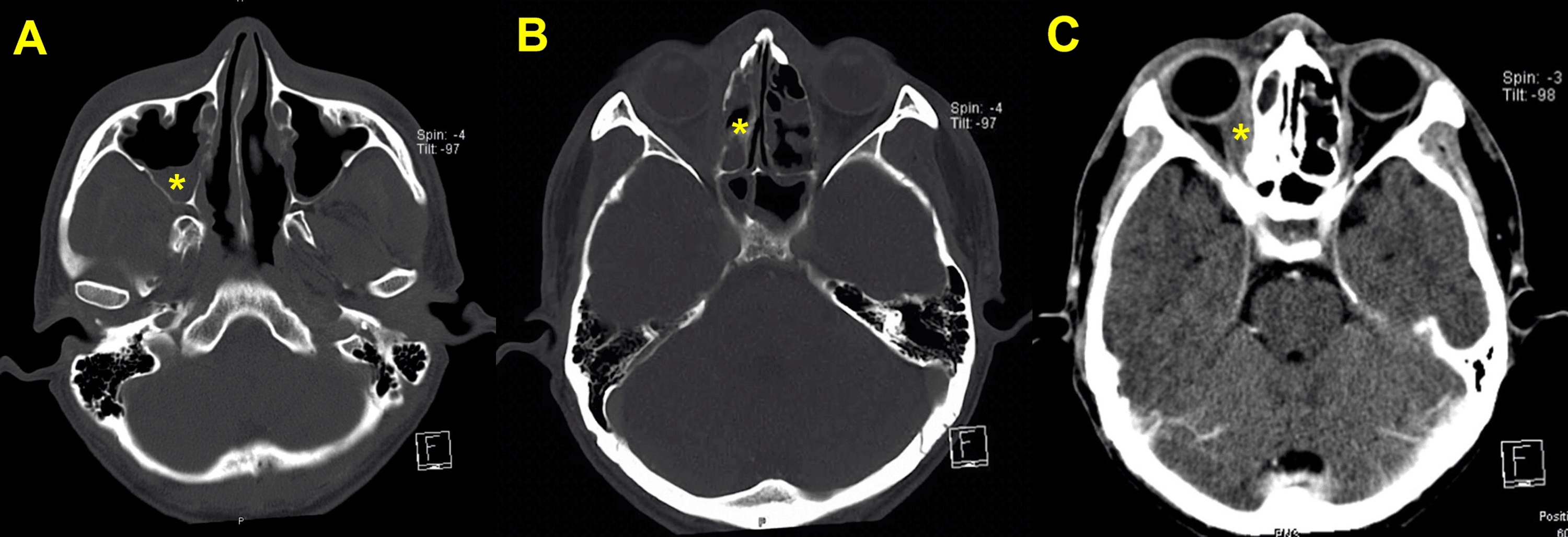 Cureus A Case of Extranodal NK/Tcell Lymphoma Infiltrating Kidneys