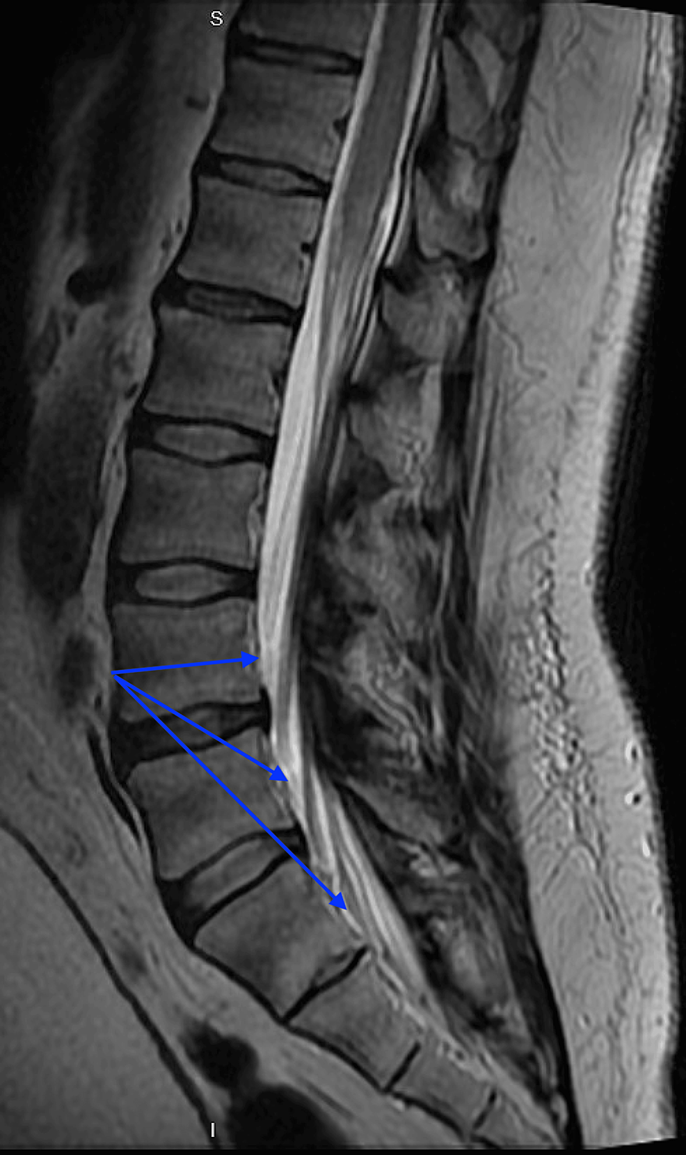 Neurosarcoidosis A Unique Presentation Of A Rare Disease Cureus neurosarcoidosis-a-unique-presentation-of-a-rare-disease-cureus