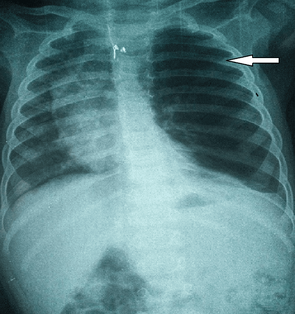 Cureus Congenital Lobar Emphysema in Children Case Series