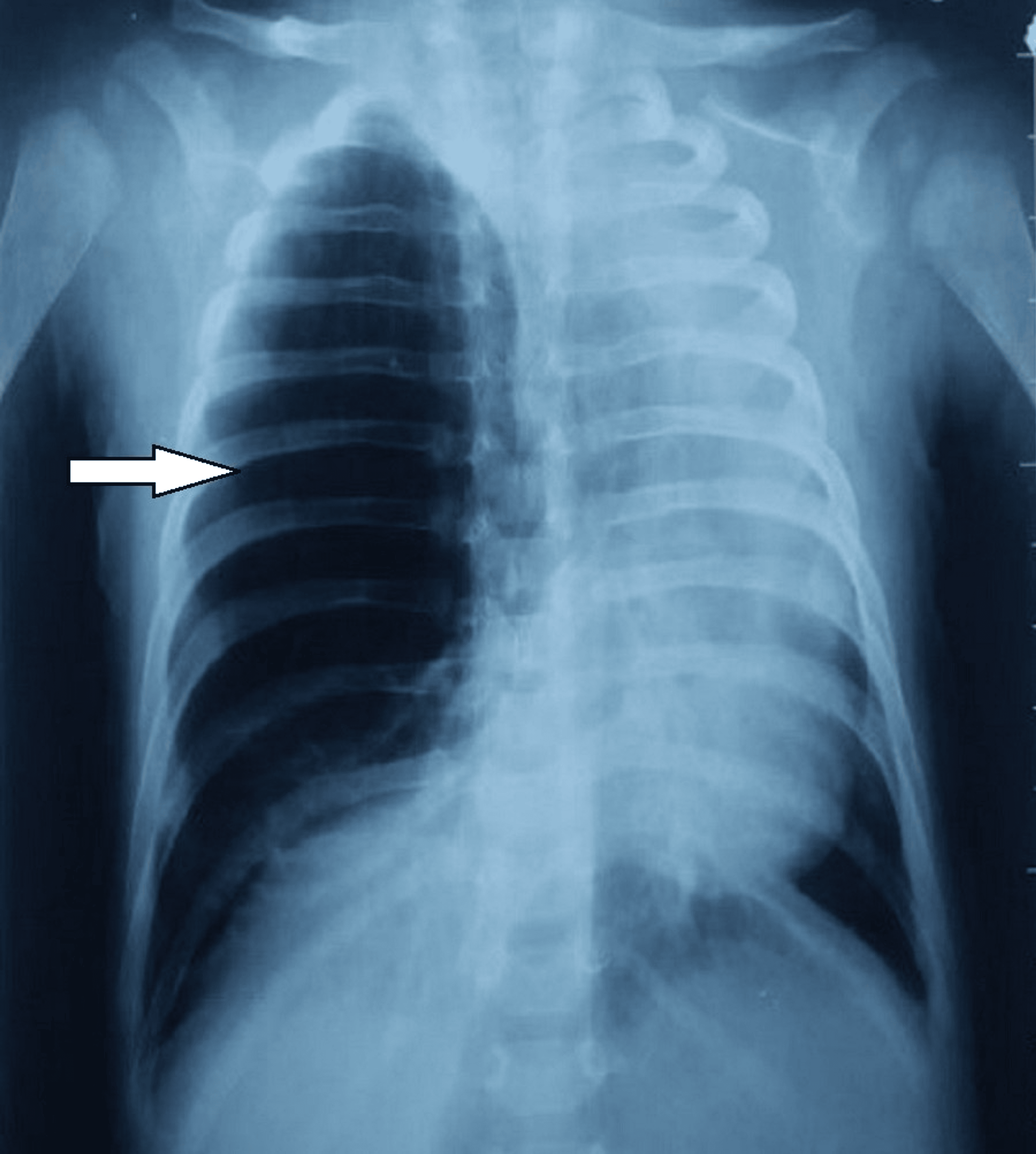 Cureus Congenital Lobar Emphysema in Children Case Series