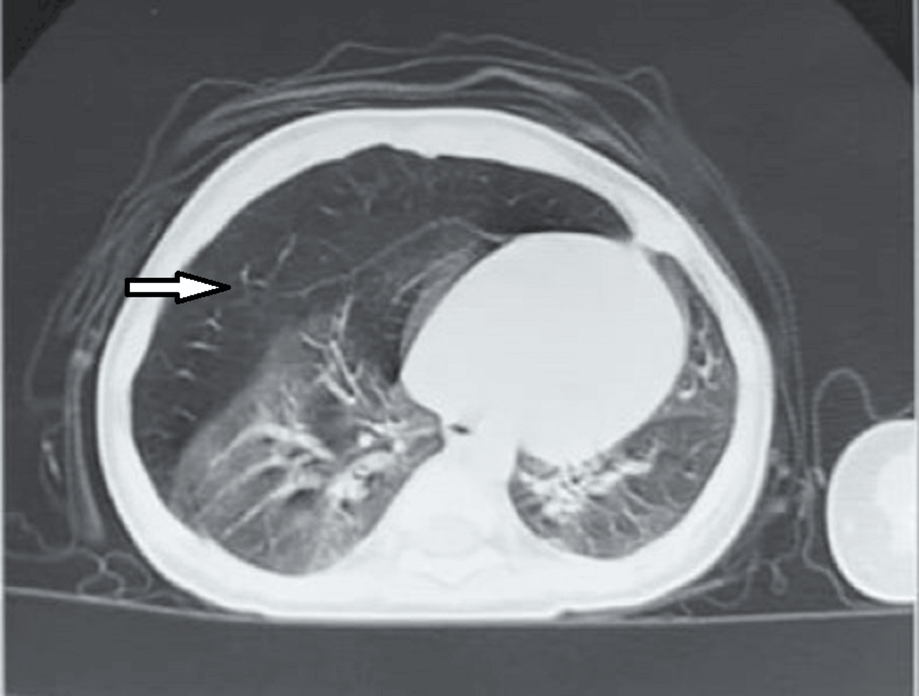 Cureus Congenital Lobar Emphysema in Children Case Series