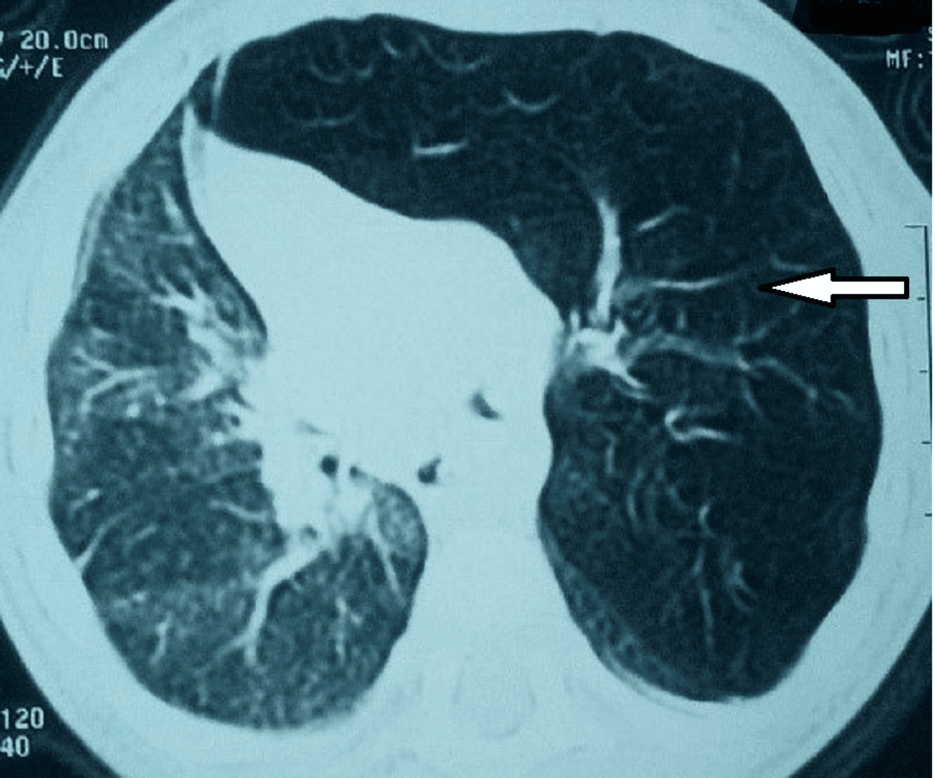 Cureus Congenital Lobar Emphysema in Children Case Series