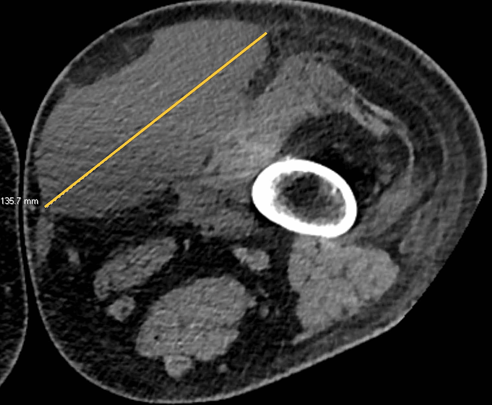 Cureus A Complex Surgical Case of a MorelLavallee Lesion