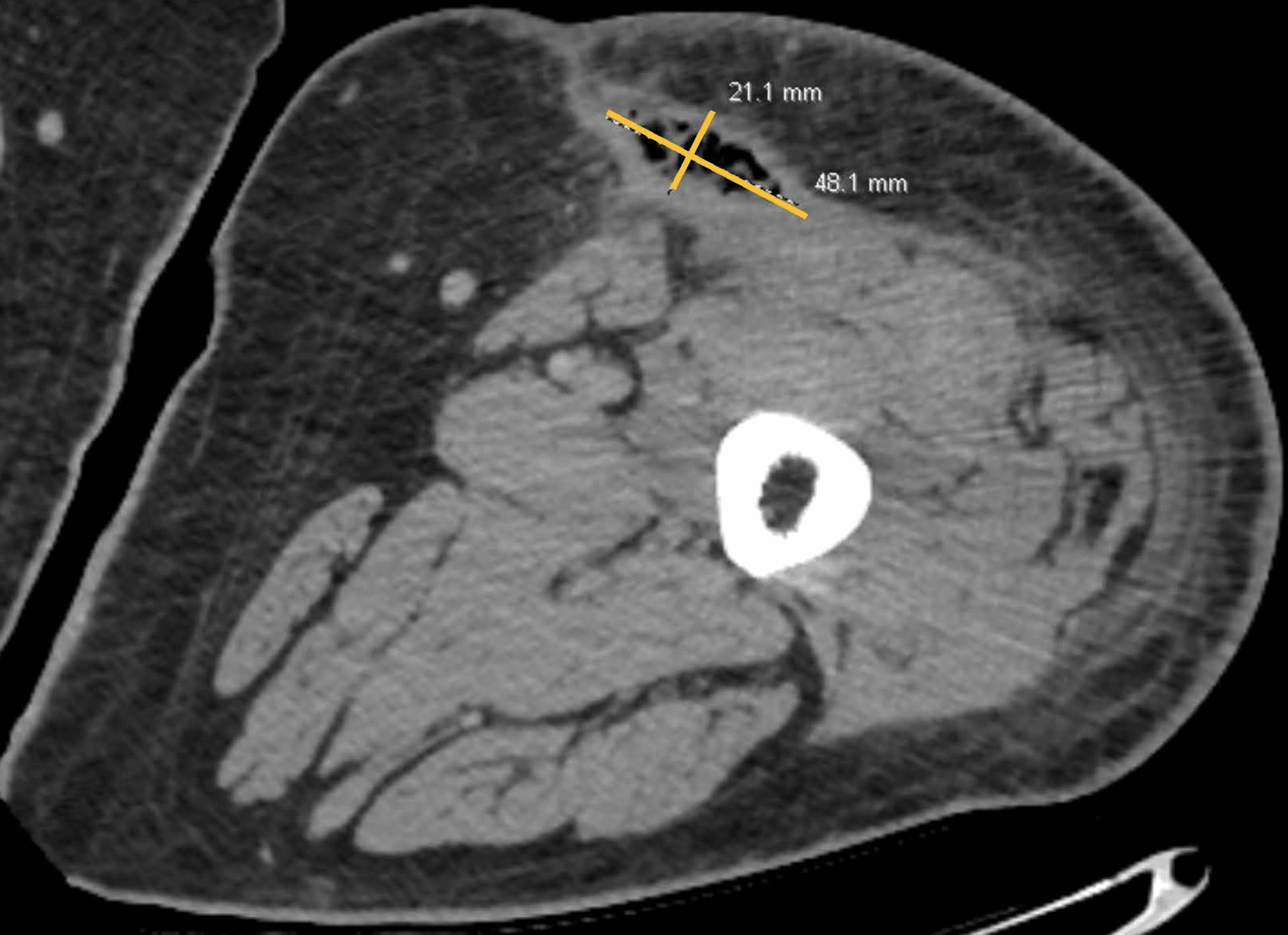A Complex Surgical Case of a MorelLavallee Lesion Cureus