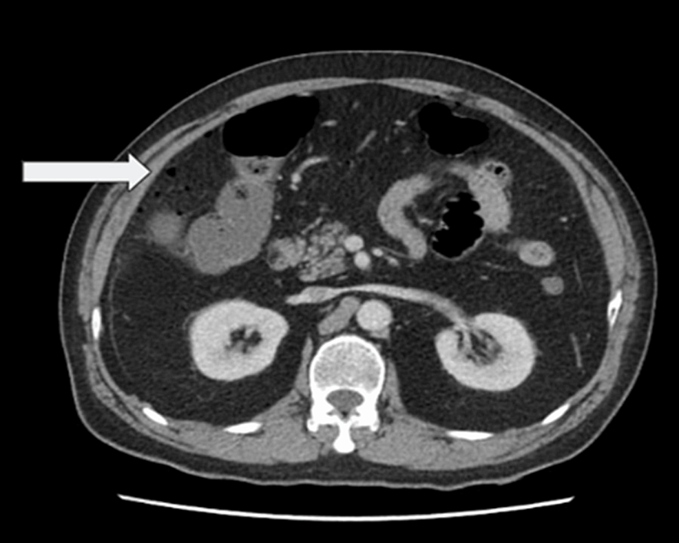Abdominal Ct Scan Showed Multiple Intrahrpatic Lesion vrogue.co