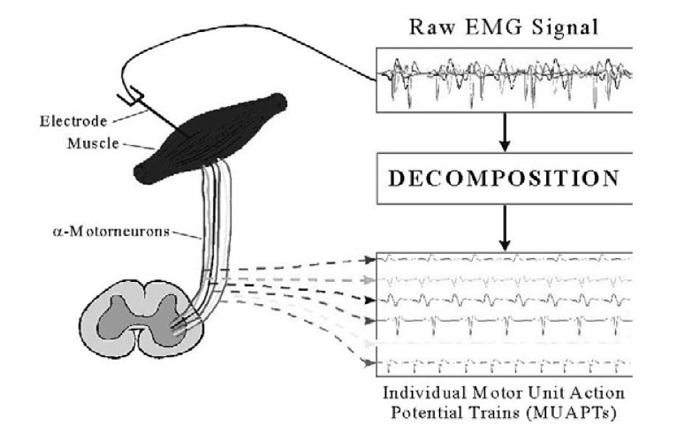 Cureus Electromyography Processing Muscles Electric Signal