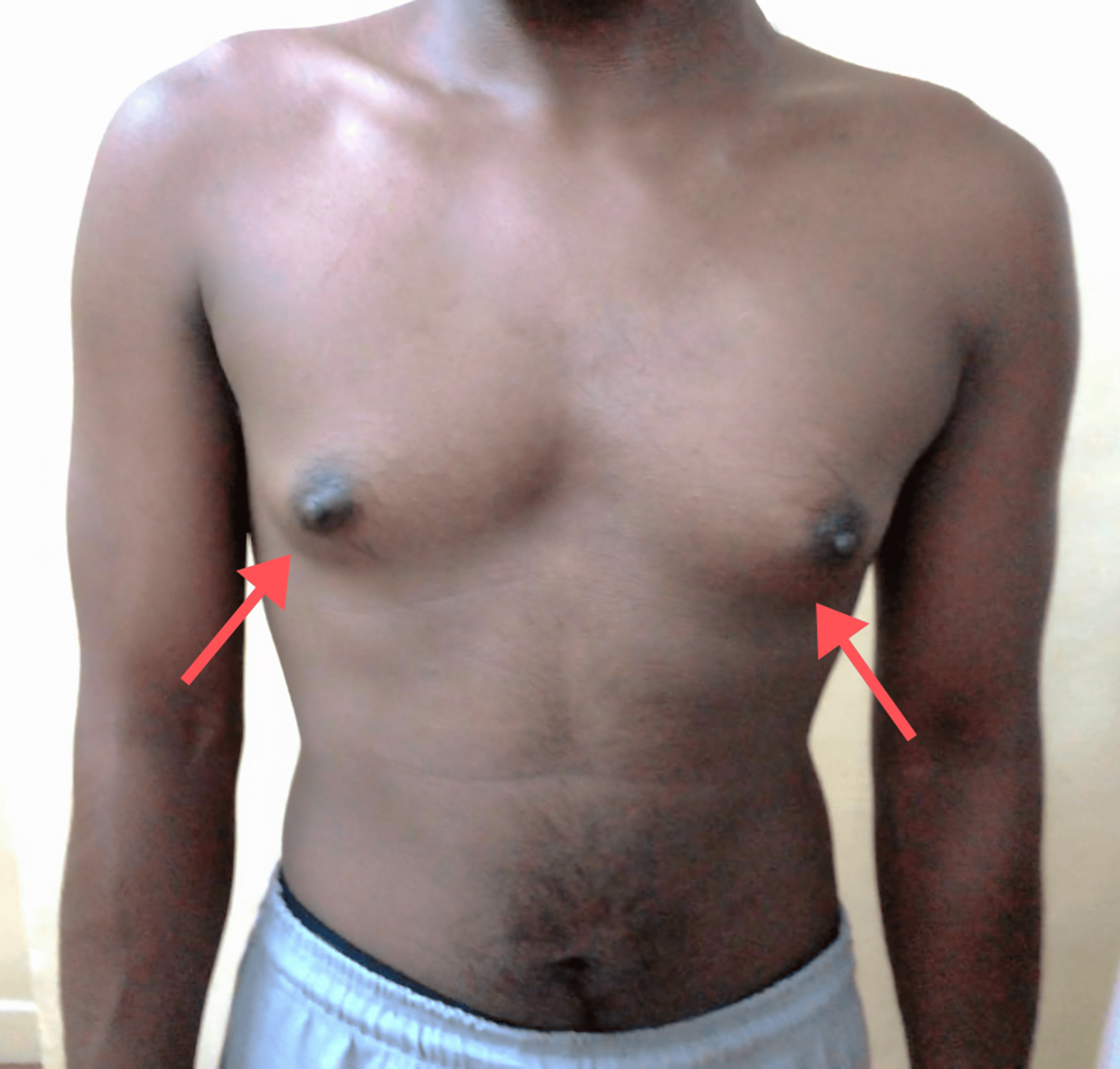 Beyond Binary Gender Reassignment in a Case of 11β-Hydroxylase Deficiency Cureus