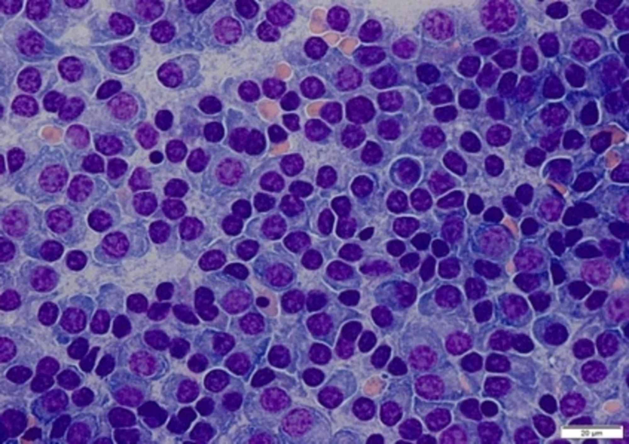 A Case of Multiple Myeloma Presenting 