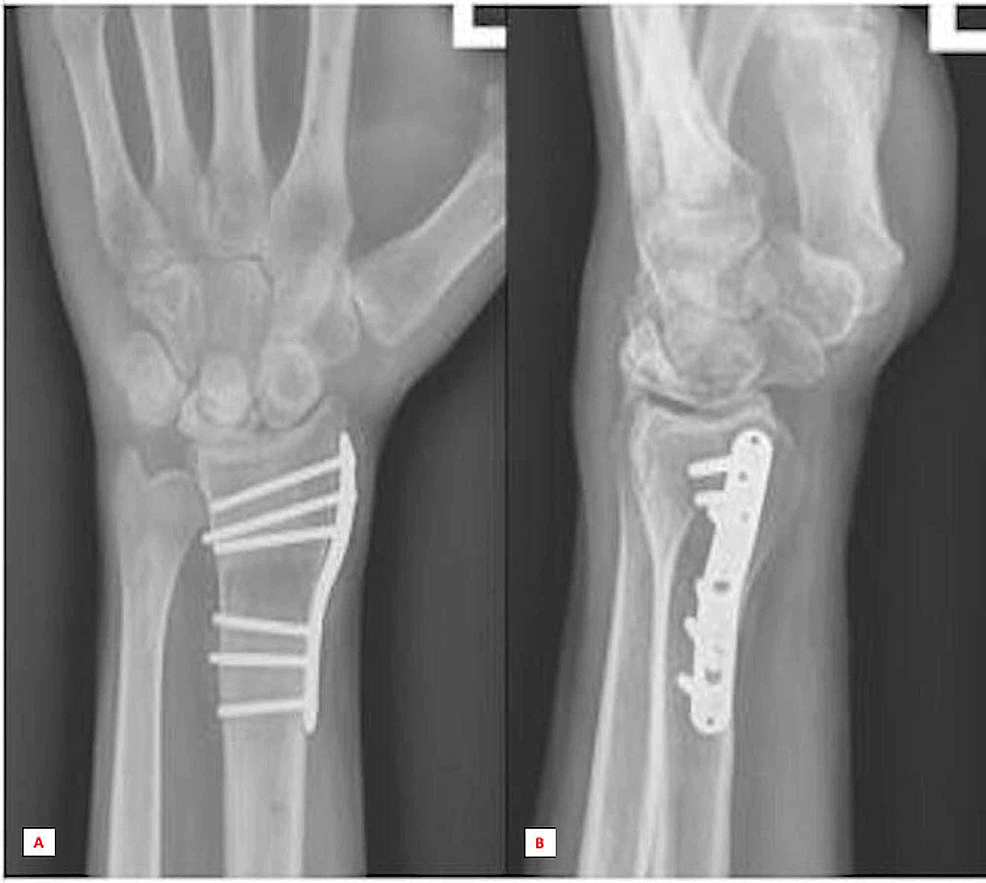 Cureus Repetitive Microtrauma and Negative Ulnar Variance as Possible