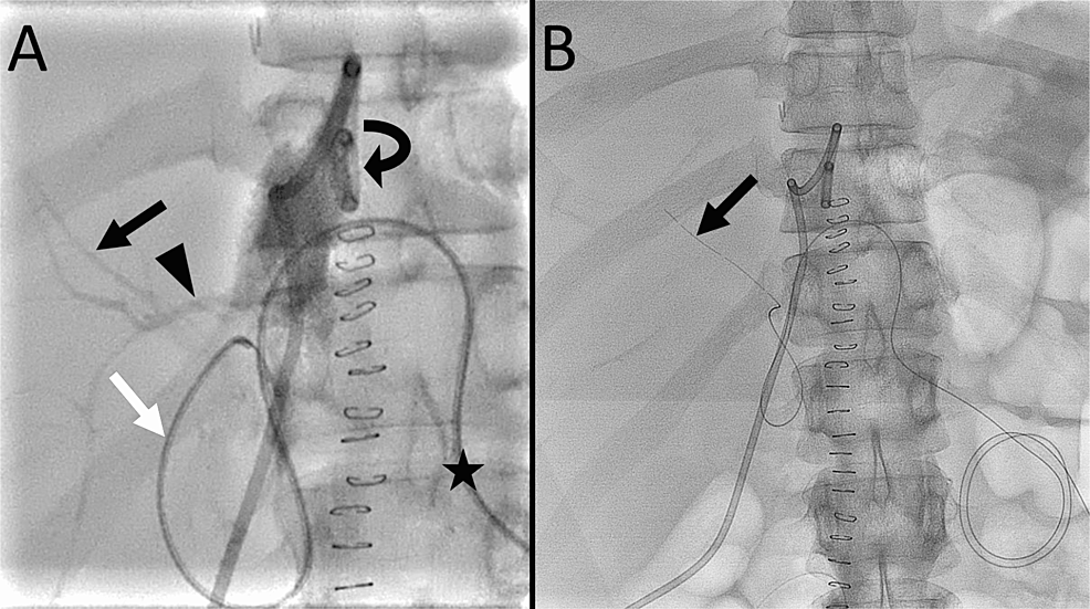 Dual Lumen Microcatheter in Percutaneous Biliary Drainage for