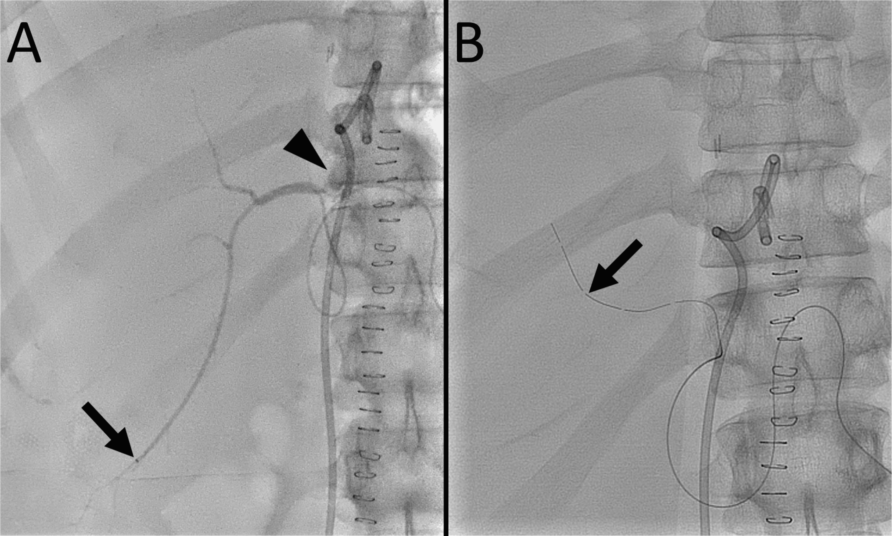 Cureus Dual Lumen Microcatheter in Percutaneous Biliary Drainage for