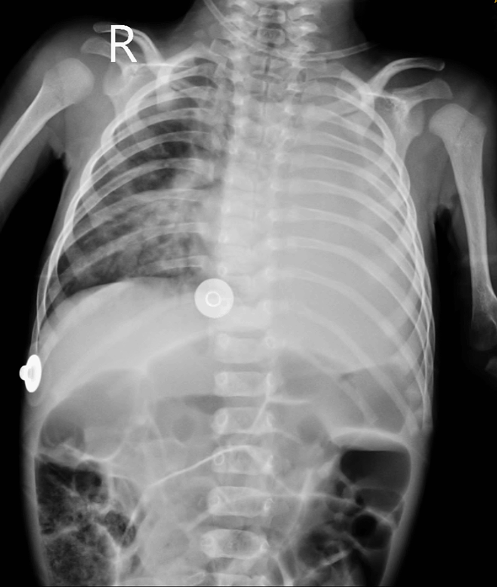 Pre-operative-chest-radiograph-showing-diffuse-haziness-in-the-left-lung-field Pre-operative-chest-radiograph-showing-diffuse-haziness-in-the-left-lung-field