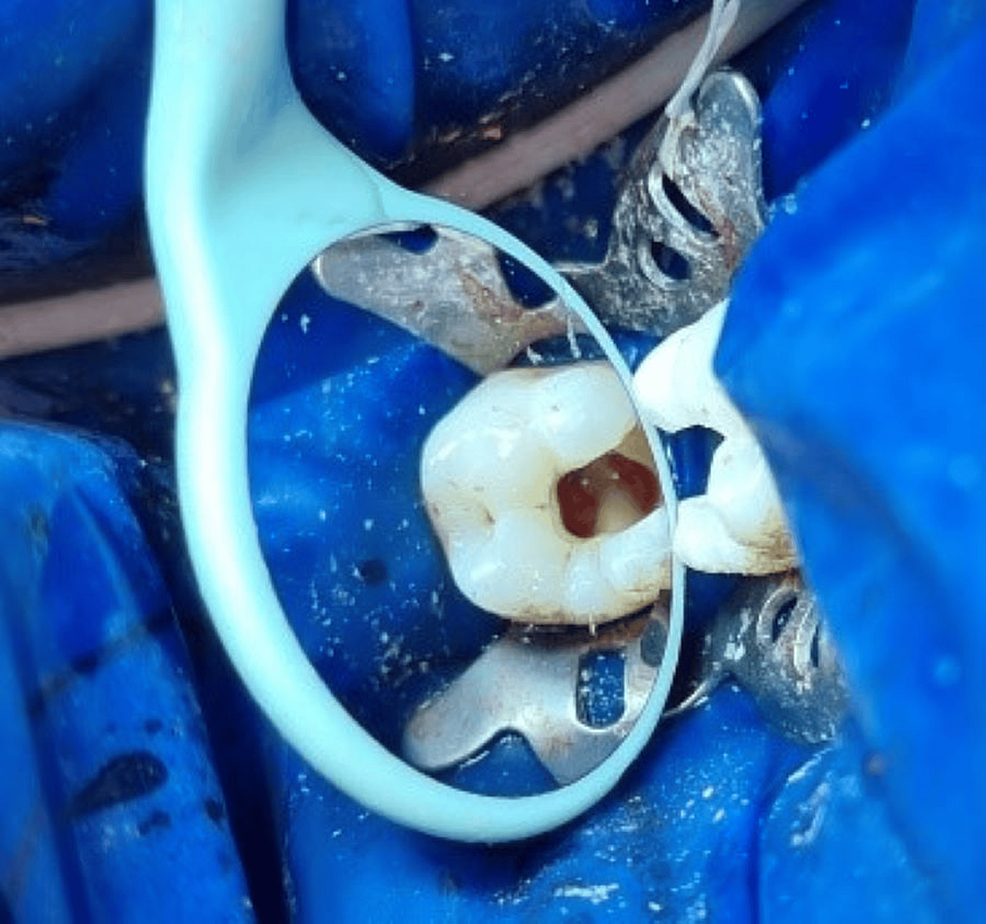 Pulpotomy for the Management of Irreversible Pulpitis in Mature Teeth