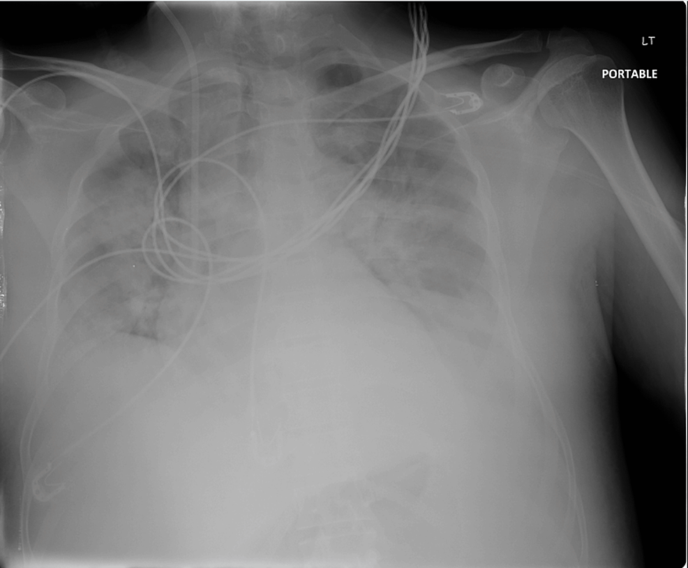 Cureus STElevation Myocardial Infarction in a 56YearOld Man With