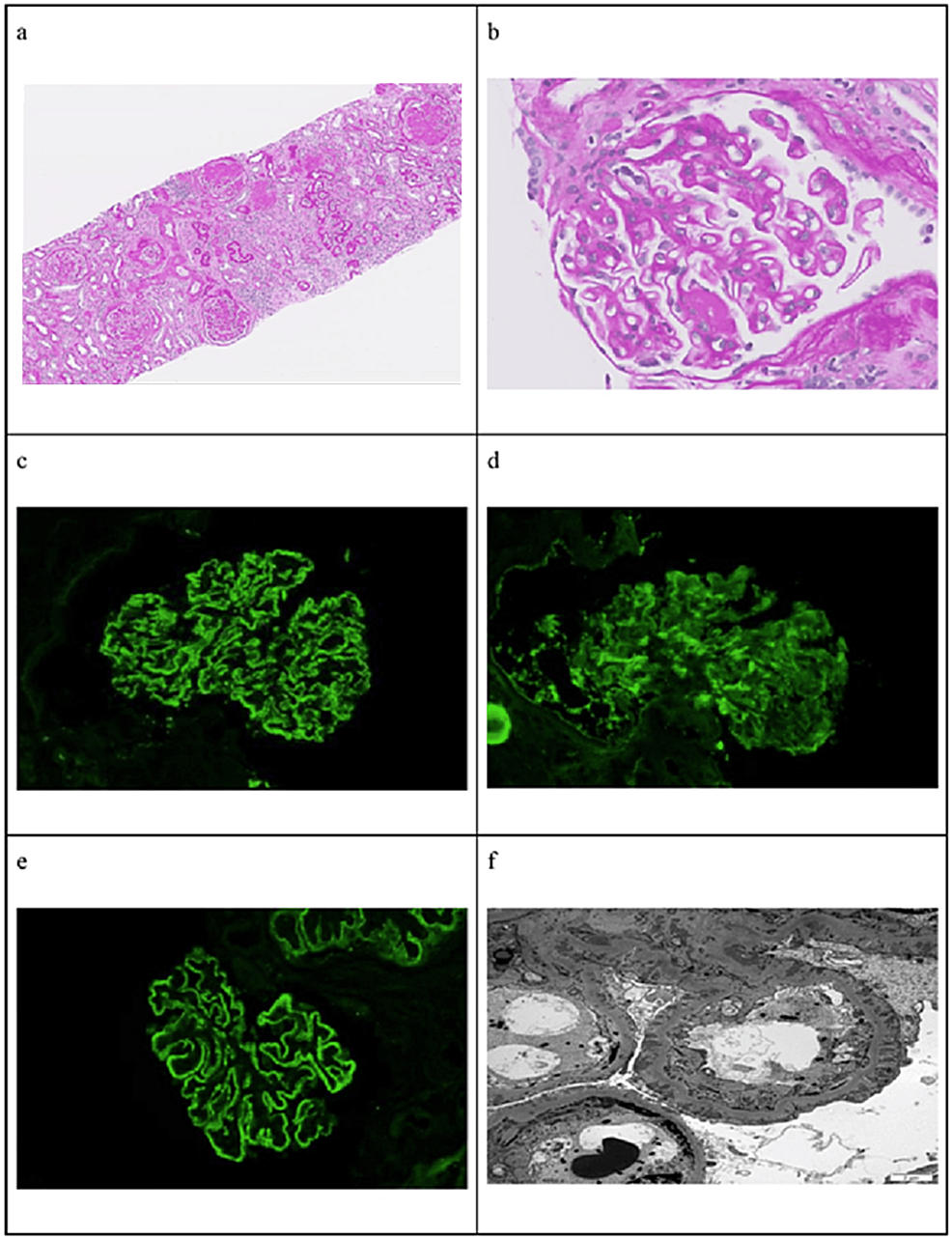 Overlap of Primary Membranous Nephropathy, IgA Nephropathy, and