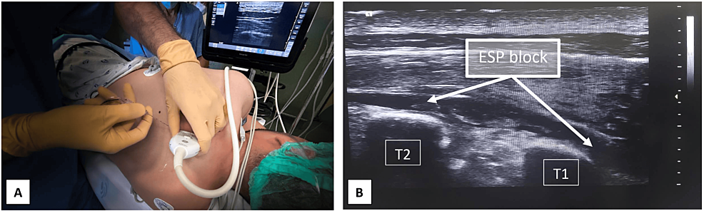 How I do it. Thoracic outlet syndrome and the transaxillary approach -  Journal of Vascular Surgery Cases, Innovations and Techniques