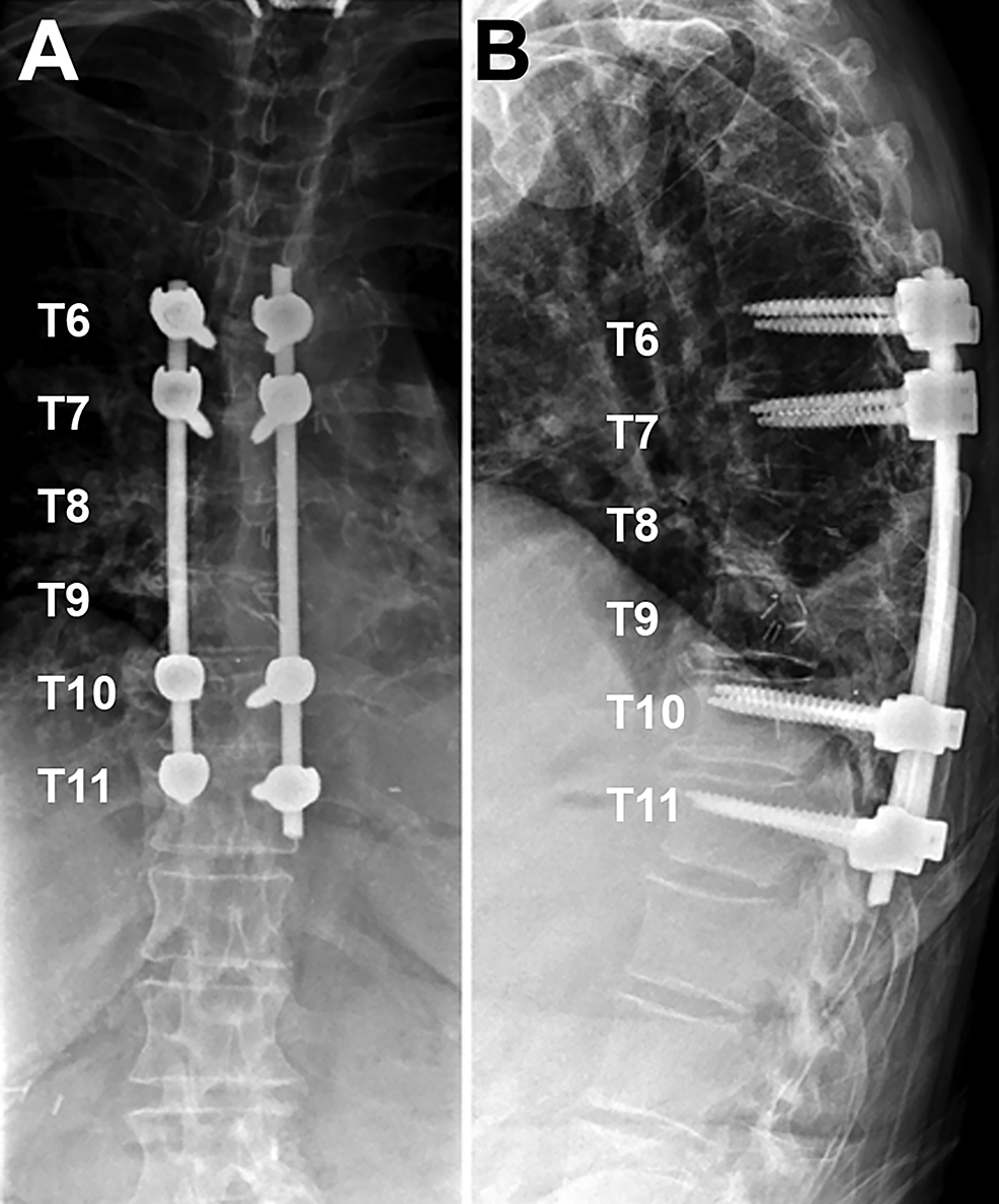 Cureus A Case of Ventral Spinal Cord Herniation from a Chronic Dural