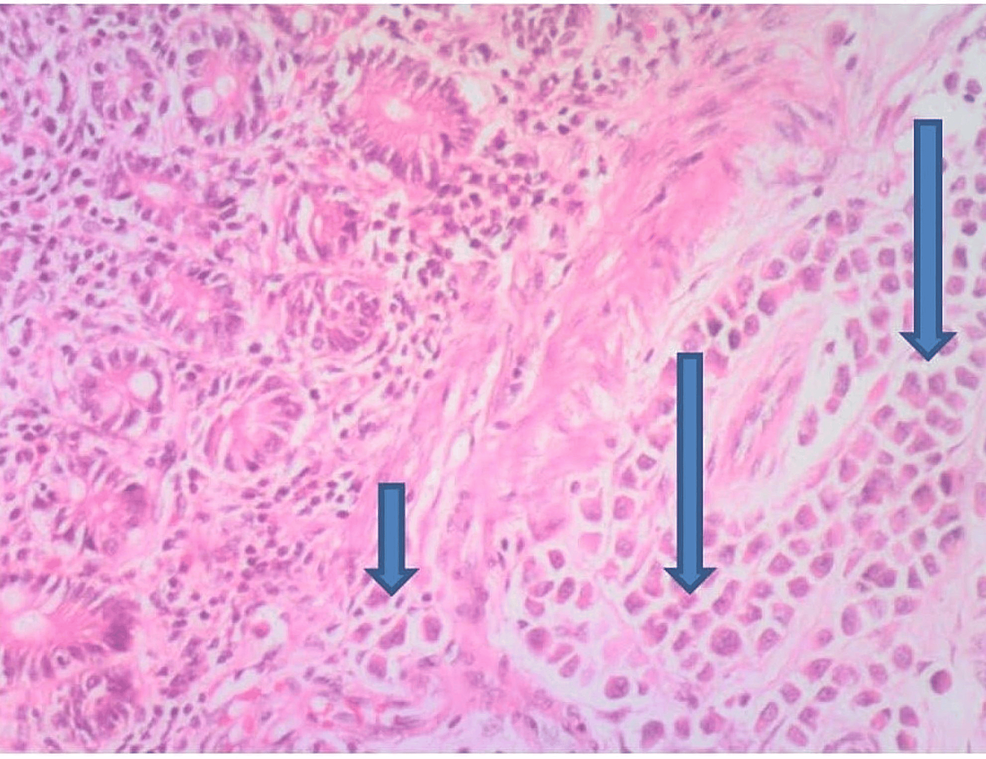 cureus-atypical-presentation-of-breast-cancer-metastasis-to-the-bowel