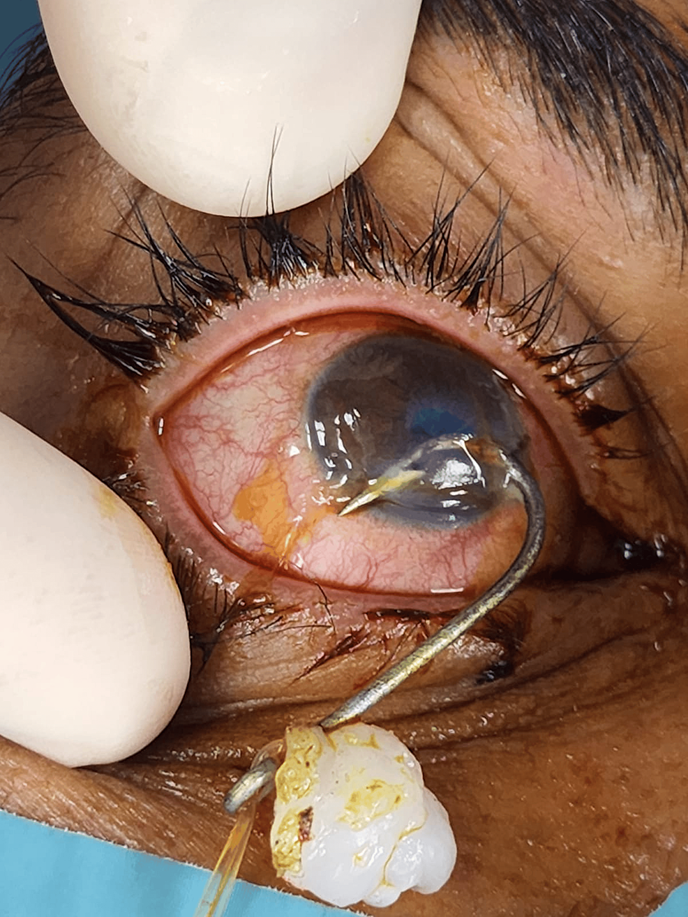 Cureus, Penetrating Ocular Fish-Hook Injury