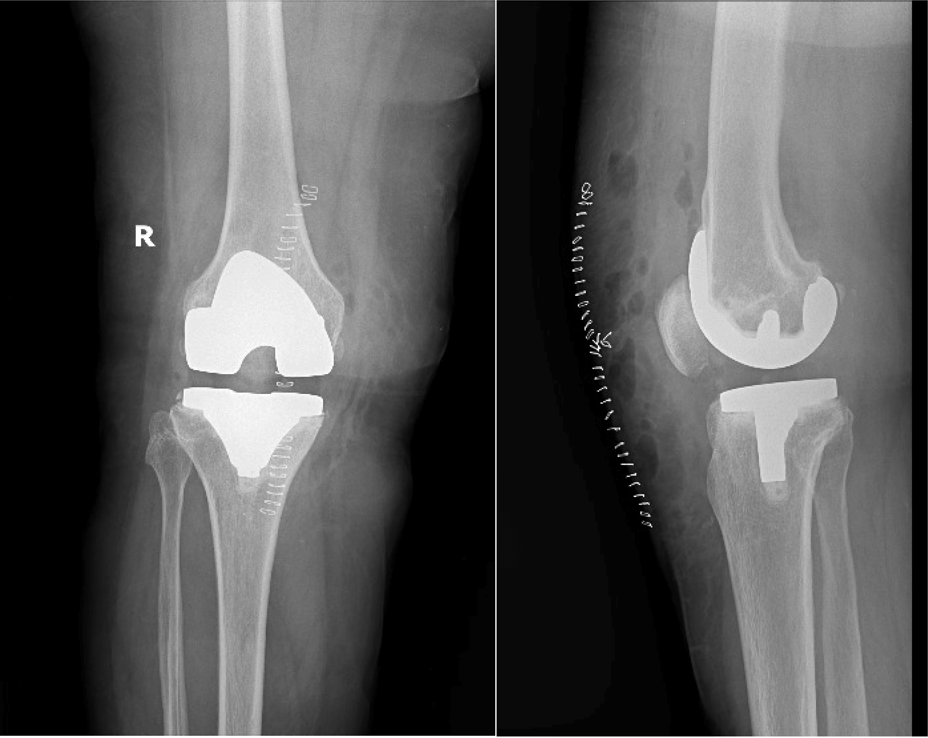 Patellar Dislocation Masking a Tibial Post Fracture An Unusual Complication of Posterior