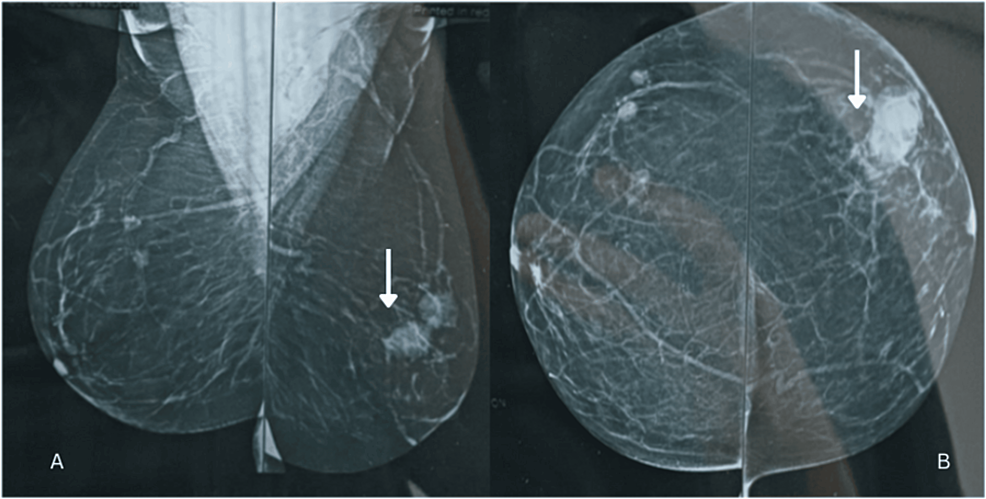 Plasmacytoma of the breast. Left mammogram shows (A) a small well