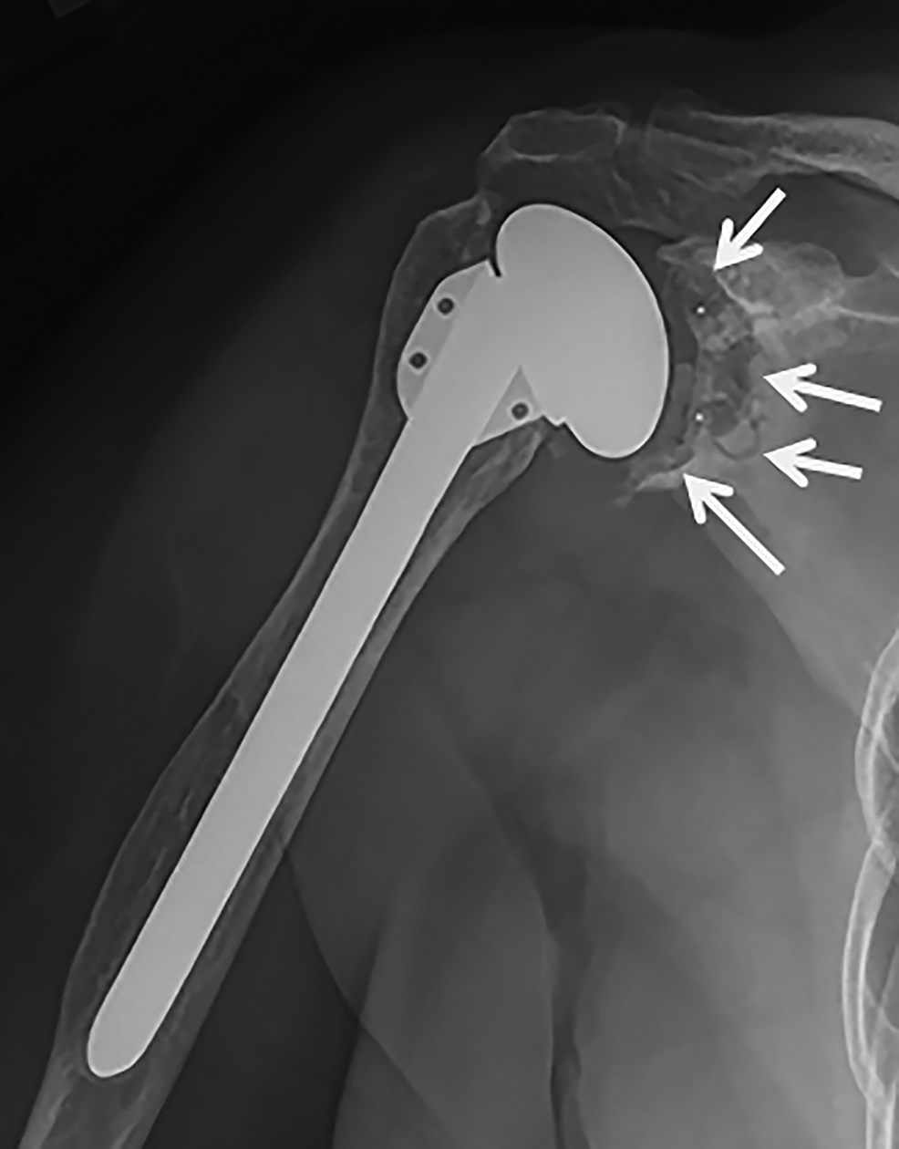 Cureus Does Prolonged Use of Walkers in Shoulder Arthroplasty