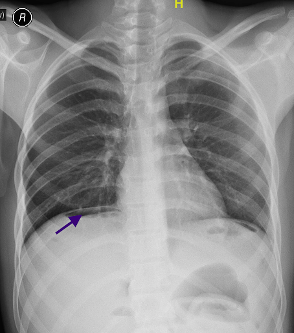 Delayed Presentation of Complete Ileal Transection Following Blunt ...