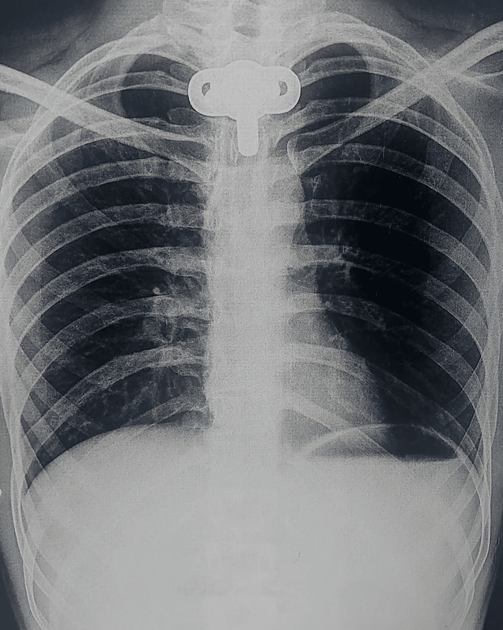 Chest-X-ray-on-the-day-of-admission