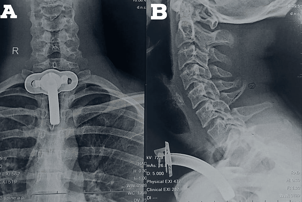 (A)-X-ray-cervical-spine-AP;-(B)-X-ray-cervical-spine-lateral