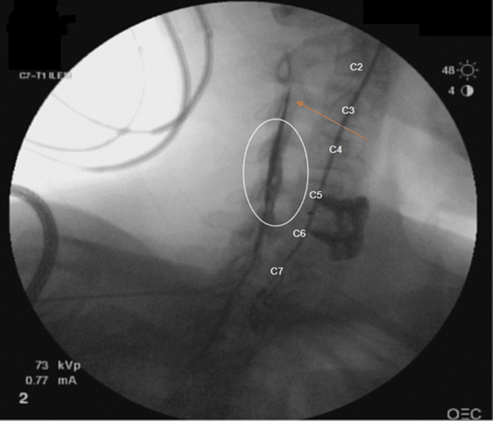 Cureus Epidural Catheters for Cervical Epidural Steroid Injections to