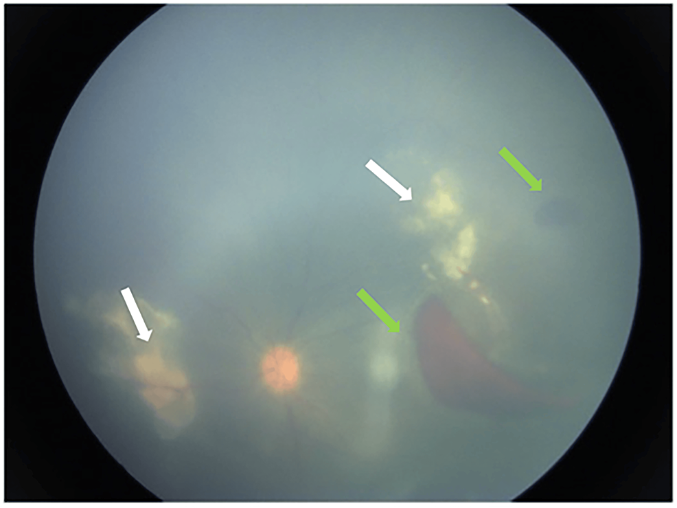 Cureus | mixed clinical pictures of endogenous endophthalmitis in a