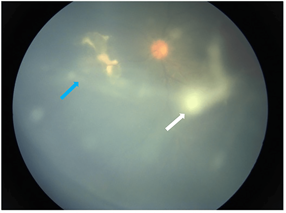 Cureus | mixed clinical pictures of endogenous endophthalmitis in a