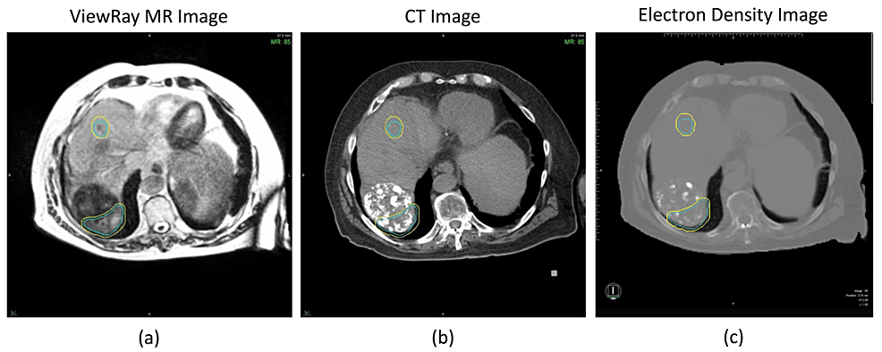 Radiation dose and incidence of new metastasis in the anterior