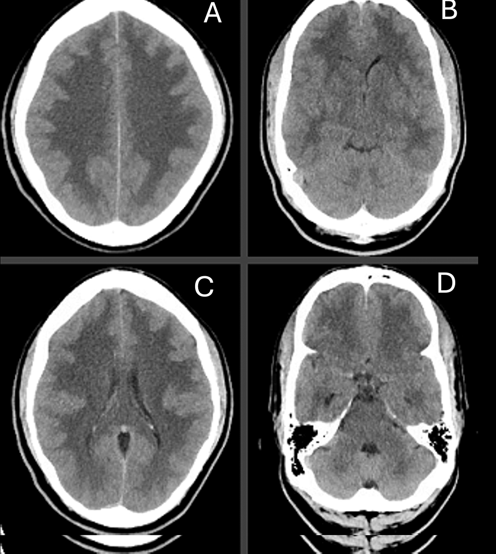 Cureus | A Case of West Nile Encephalitis: Neuroimaging Findings and ...