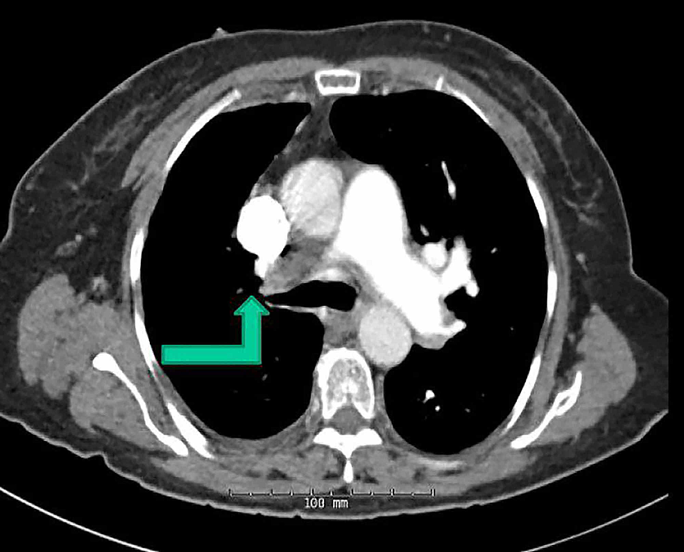 Cureus | A Rare Case of Isolated Unilateral Atresia of Pulmonary Artery ...