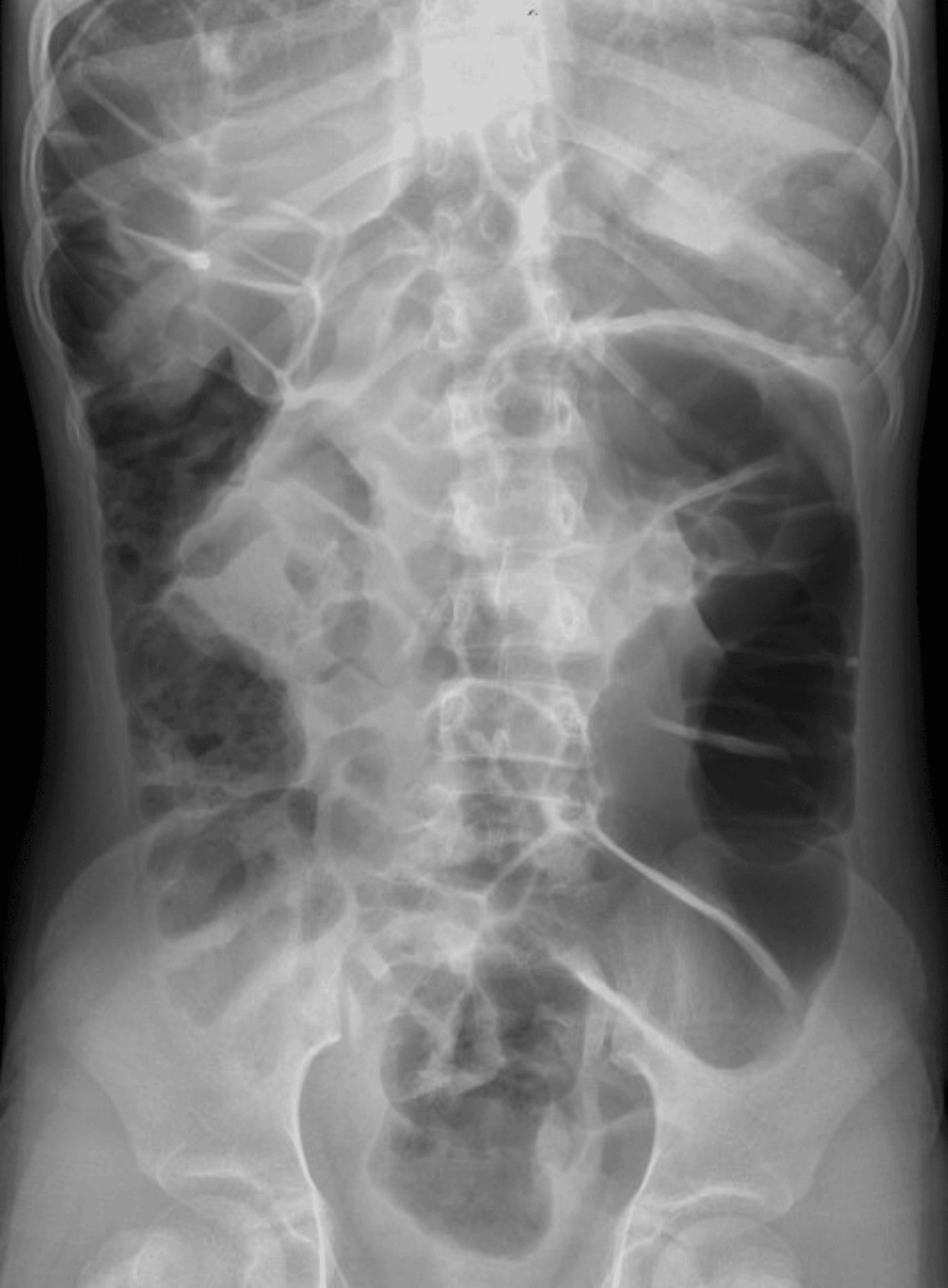 A Rare Presentation Of Pseudo-pneumoperitoneum Secondary To Chilaiditi 