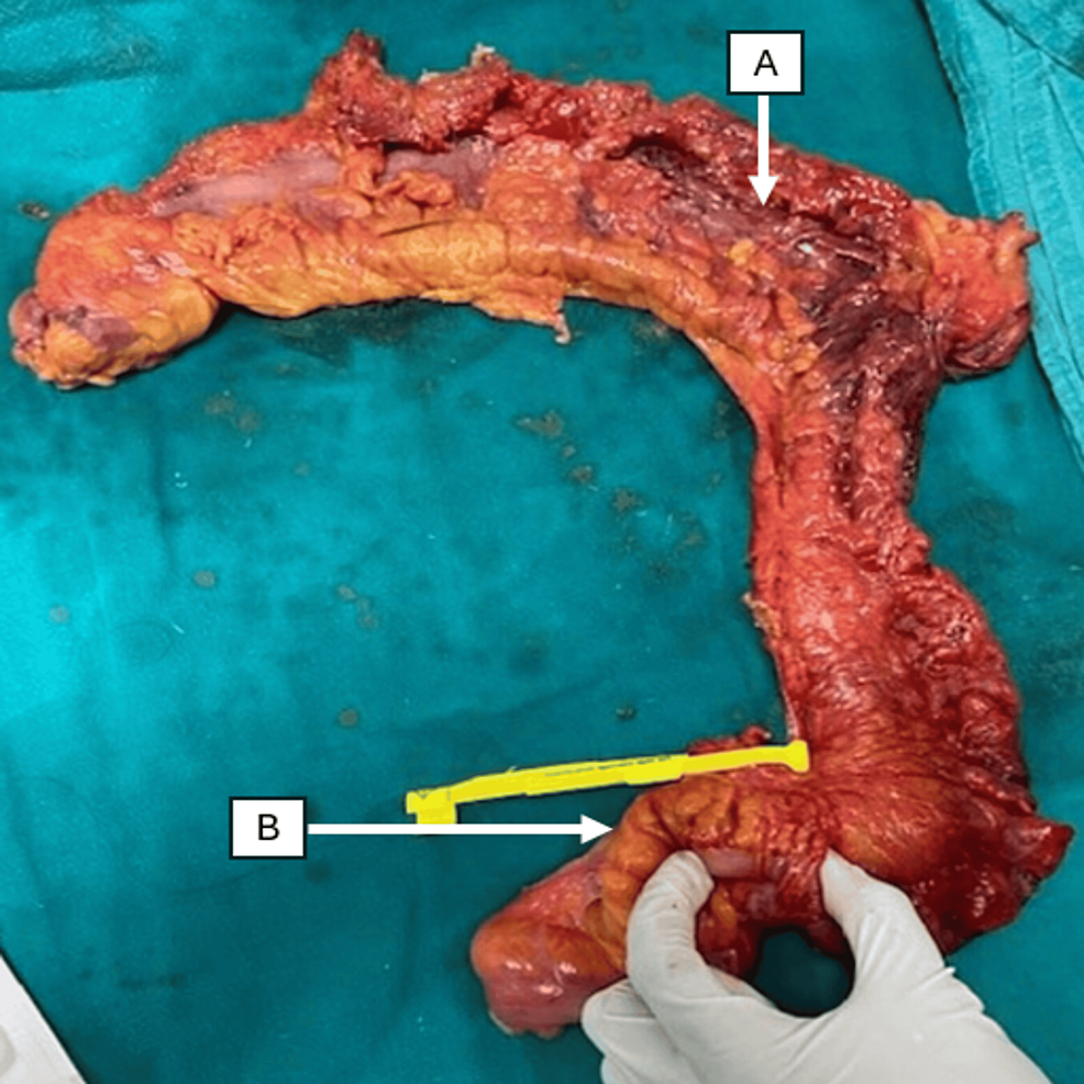 Impact of Primary Tumor Resection on Type B Lactic Acidosis in a Case of Metastatic Colon Cancer - Cureus