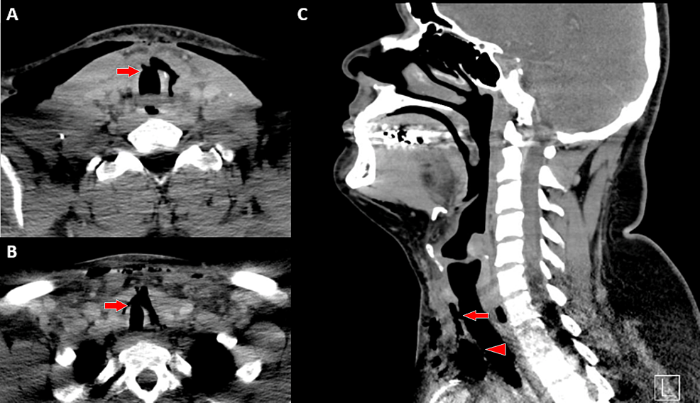 Cureus Delayed Multifocal Tracheal Injury Following Thyroidectomy A