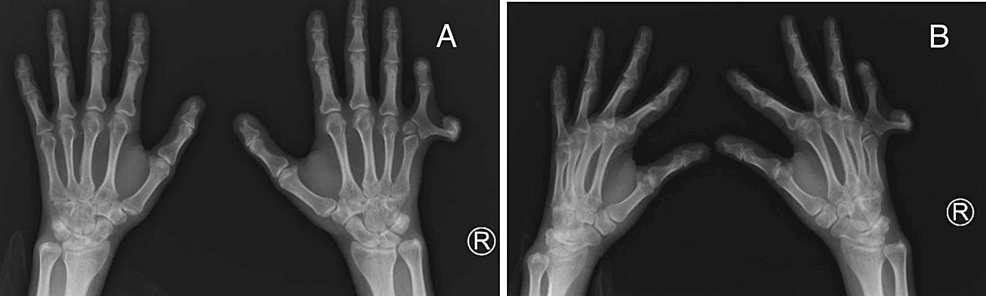 Long-term results following osteotomy of the thumb delta phalanx