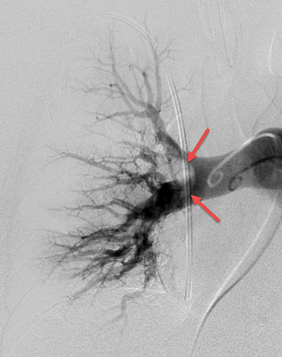 Cureus Mechanical Thrombectomy for Submassive Pulmonary Embolism in