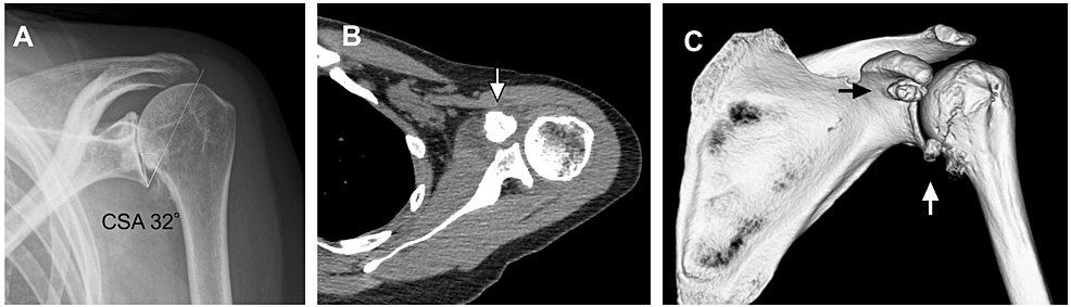 Cureus | discovering the forgotten trauma behind chronic shoulder pain