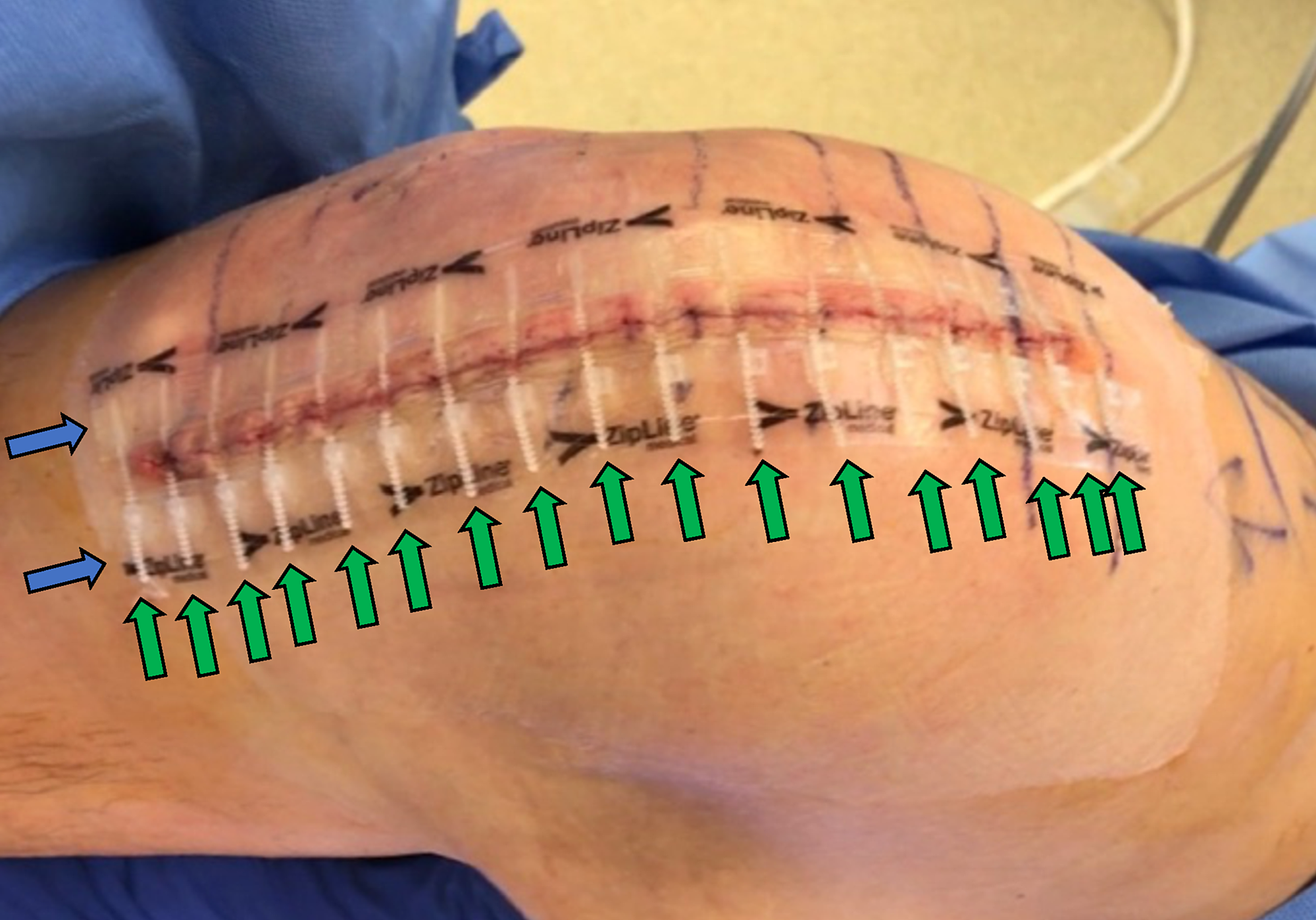 Cureus Patient Satisfaction and Cosmetic in a Randomized, Prospective Study of Total