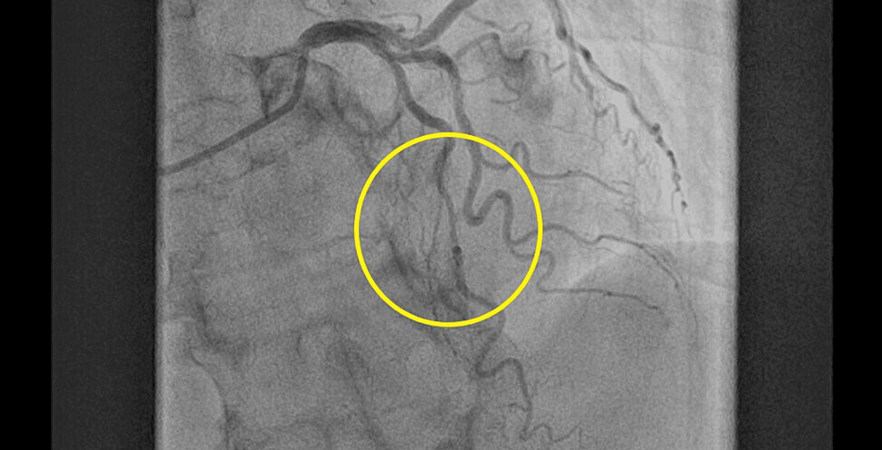 Update on Myocardial Bridging