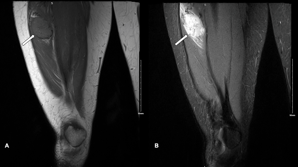 Alveolar Soft Tissue Sarcoma in the Right Thigh: A Case Study at King ...