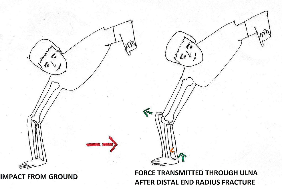 Cureus A Rare Combination of Complex Elbow Dislocation and Distal