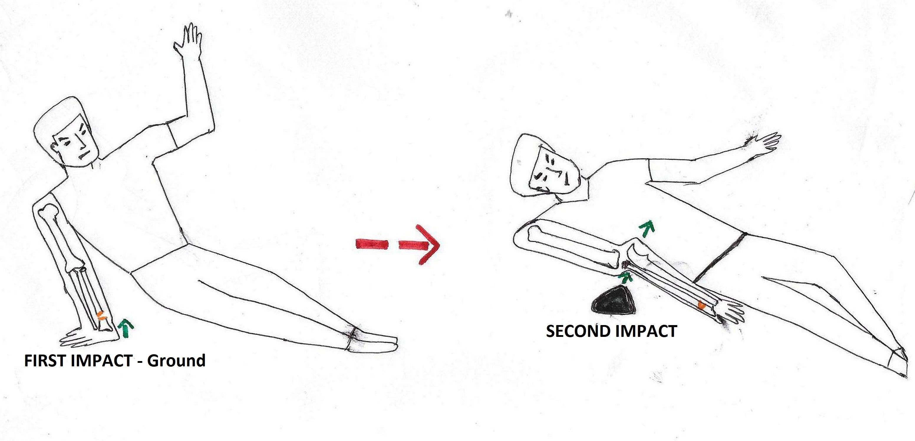 Cureus | A Rare Combination of Complex Elbow Dislocation and Distal ...